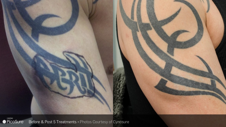 Revive Spa Services  Tattoo Removal  Reid Health