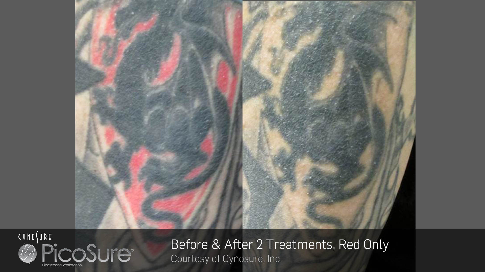 Laser Tattoo Removal Results  Winnipeg MB  Total Wrapture Medi Spa