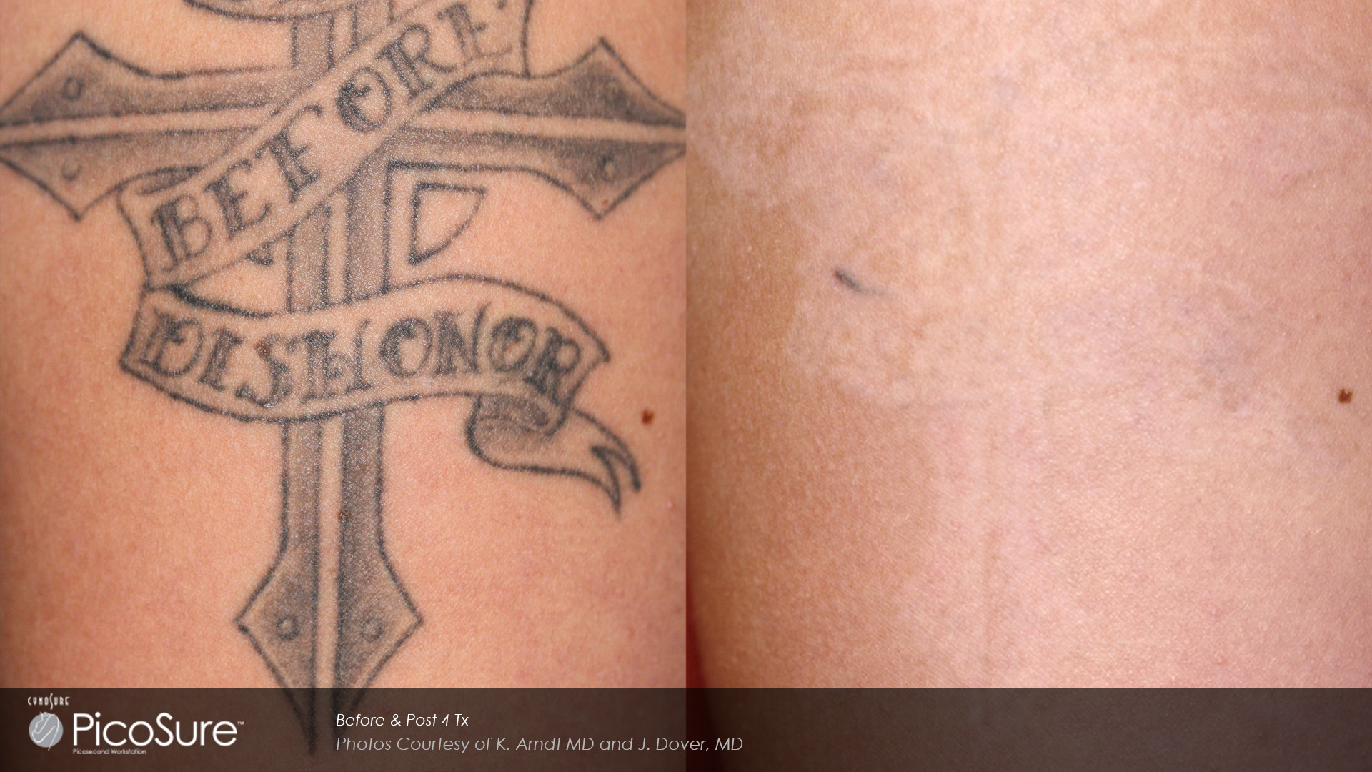 laser tattoo removal please help text will be posted in comments  r tattoo